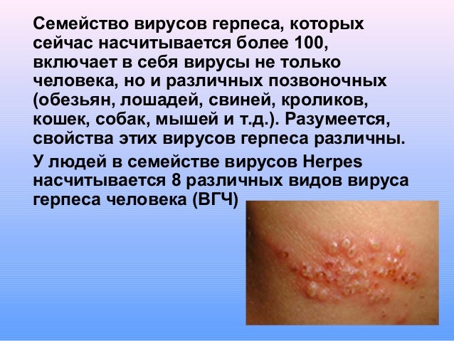 Вирус герпеса