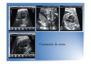 Coartación de aorta
 