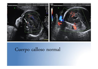 Cuerpo calloso normal
 