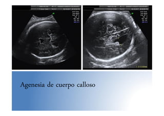 Agenesia de cuerpo calloso
 