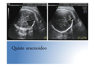 Quiste aracnoideo
 