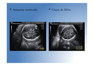• Asimetría ventricular • Cisura de Silvio
 