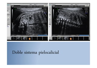 Doble sistema pielocalicial
 
