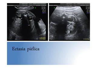 Ectasia piélica
 