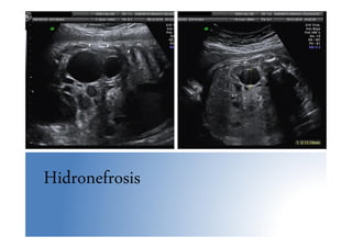Hidronefrosis
 