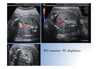 RD ausente+ RI displásico
 
