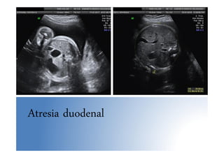 Atresia duodenal
 