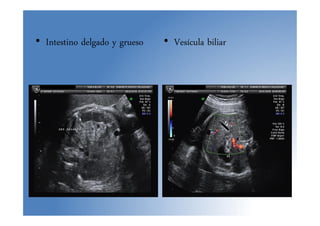 • Intestino delgado y grueso • Vesícula biliar
 