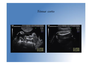 Fémur corto
 
