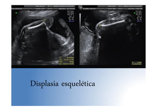 Displasia esquelética
 