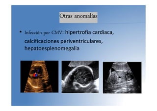 Otras anomalías
• Infección por CMV: hipertrofia cardiaca,
calcificaciones periventriculares,
hepatoesplenomegalia
 