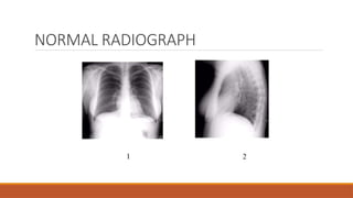 NORMAL RADIOGRAPH
 