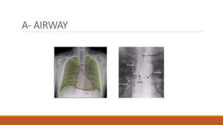 A- AIRWAY
 