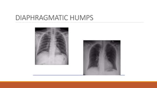 DIAPHRAGMATIC HUMPS
 