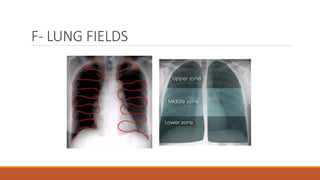 F- LUNG FIELDS
 