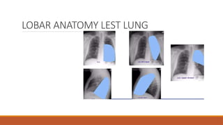 LOBAR ANATOMY LEST LUNG
 