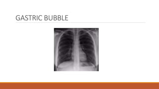 GASTRIC BUBBLE
 