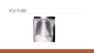 ICU TUBE
 