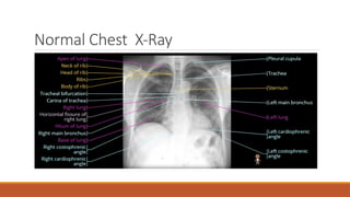 Normal Chest X-Ray
 