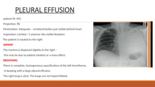 PLEURAL EFFUSION
patient ID: XYZ.
Projection: PA
Penetration: Adequate – vertebral bodies just visible behind heart
Inspiration: Limited - 5 anterior ribs visible Rotation:
The patient is rotated to the right
AIRWAY
The trachea is displaced slightly to the right –
this may be due to patient rotation or a mass effect.
BREATHING
There is complete, homogeneous opacification of the left hemithorax,
in keeping with a large pleural effusion.
The right lung is clear. The lungs are not hyperinflated.
 