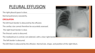 PLEURAL EFFUSION
The right pleural space is clear.
Normal pulmonary vascularity.
CIRCULATION
The left heart border is obscured by the effusion.
The cardiac size cannot therefore be accurately assessed.
The right heart border is clear.
The thoracic aorta is obscured.
The mediastinum is central, not widened, with a clear right border.
The left border is obscured.
The left hilum is obscured by the effusion. Normal size, shape, and position of the right hilum.
 