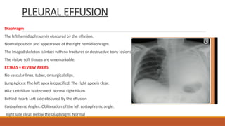 PLEURAL EFFUSION
Diaphragm
The left hemidiaphragm is obscured by the effusion.
Normal position and appearance of the right hemidiaphragm.
The imaged skeleton is intact with no fractures or destructive bony lesions visible.
The visible soft tissues are unremarkable.
EXTRAS + REVIEW AREAS
No vascular lines, tubes, or surgical clips.
Lung Apices: The left apex is opacified. The right apex is clear.
Hila: Left hilum is obscured. Normal right hilum.
Behind Heart: Left side obscured by the effusion
Costophrenic Angles: Obliteration of the left costophrenic angle.
Right side clear. Below the Diaphragm: Normal
 