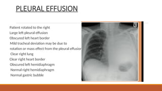 PLEURAL EFFUSION
Patient rotated to the right
Large left pleural effusion
Obscured left heart border
Mild tracheal deviation may be due to
rotation or mass effect from the pleural effusion
Clear right lung
Clear right heart border
Obscured left hemidiaphragm
Normal right hemidiaphragm
Normal gastric bubble
 