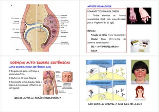 ARTRITE REUMATÓIDE

                                         DIAGNÓSTICO IMUNOLÓGICO

                                          -    Títulos   elevados   de    fatores
                                         reumatóides (IgM com especificidade
                                         para o fragmento Fc da IgG)



                                         Métodos:

                                              Fixação do látex (fator reumatóide)

                                              Waaler     Rose   (Eritrócitos   de
                                         carneiro sensibilizados)

                                              IFI = ANTIPROFILAGRINA

                                              ELISA




 DOENÇAS AUTO-IMUNES SISTÊMICAS
LUPUS ERITEMATOSO SISTÊMICO (LES)

# Erupções de pele e artralgia e
glomerulonefrite.
# Mulheres, 30 anos, Negras
# Raramente antes da puberdade e
depois da menopausa (influência do
estrógeno);




      QUAIS AUTO-Ac ESTÃO ENVOLVIDOS ?

                                         SÃO AUTO-Ac CONTRA O DNA DAS CÉLULAS !!!
 