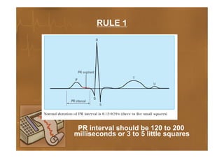 Pr Interval Ruler Basics of ECG | PDF