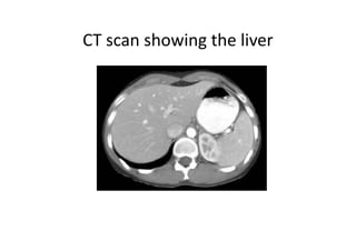 CT scan showing the liver
 