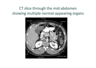 CT slice through the mid-abdomen
showing multiple normal-appearing organs
 