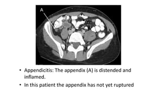 • Appendicitis: The appendix (A) is distended and
  inflamed.
• In this patient the appendix has not yet ruptured
 