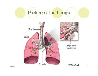 Microsoft+PowerPoint+-+LUNG+CANCER+4th+year+lecture+(1)+[Compatibility ...