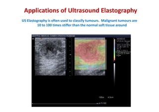 Applications of Ultrasound Elastography
US Elastography is often used to classify tumours. Malignant tumours are
         ...