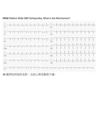 RBBB Pattern Wide QRS Tachycardia, What is the Mechanism?




38 歲男性到急診求診，主訴心悸及胸部不適。
 