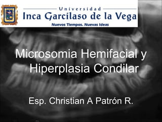 Microsomia Hemifacial y
  Hiperplasia Condilar

  Esp. Christian A Patrón R.
 