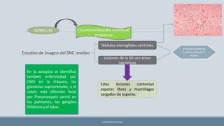 Estudios de imagen del SNC revelan:
JUAN BURGOS ARAGÓN
SOSPECHA Leucoencefalopatía multifocal
progresiva
Nódulos microgliales centrales
Lesiones de la SG con áreas
necróticas
Presentes al menos
4 meses antes de la
muerte.
Estas lesiones contenían
esporas libres y macrófagos
cargados de esporas.
En la autopsia se identificó
también enfermedad por
CMV en la tráquea, las
glándulas suprarrenales, y el
colon, más infección focal
por Pneumocystis carinii en
los pulmones, los ganglios
linfáticos y el bazo.
 