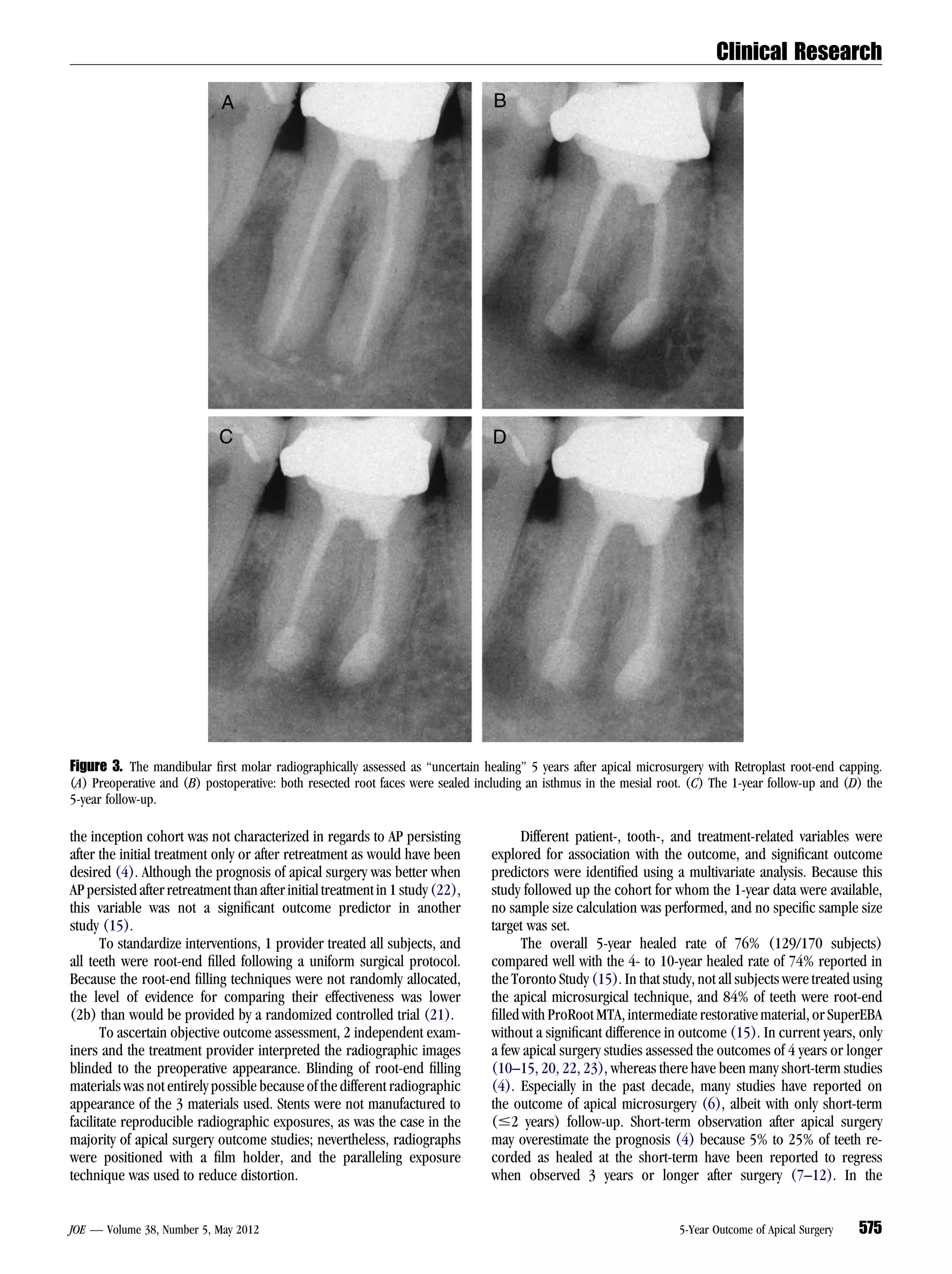 Clinical Research




Figure 3. The mandibular ﬁrst molar radiographically assessed as ‘‘uncertain healing’’ 5 years after apical microsurgery with Retroplast root-end capping.
(A) Preoperative and (B) postoperative: both resected root faces were sealed including an isthmus in the mesial root. (C) The 1-year follow-up and (D) the
5-year follow-up.

the inception cohort was not characterized in regards to AP persisting               Different patient-, tooth-, and treatment-related variables were
after the initial treatment only or after retreatment as would have been       explored for association with the outcome, and signiﬁcant outcome
desired (4). Although the prognosis of apical surgery was better when          predictors were identiﬁed using a multivariate analysis. Because this
AP persisted after retreatment than after initial treatment in 1 study (22),   study followed up the cohort for whom the 1-year data were available,
this variable was not a signiﬁcant outcome predictor in another                no sample size calculation was performed, and no speciﬁc sample size
study (15).                                                                    target was set.
       To standardize interventions, 1 provider treated all subjects, and            The overall 5-year healed rate of 76% (129/170 subjects)
all teeth were root-end ﬁlled following a uniform surgical protocol.           compared well with the 4- to 10-year healed rate of 74% reported in
Because the root-end ﬁlling techniques were not randomly allocated,            the Toronto Study (15). In that study, not all subjects were treated using
the level of evidence for comparing their effectiveness was lower              the apical microsurgical technique, and 84% of teeth were root-end
(2b) than would be provided by a randomized controlled trial (21).             ﬁlled with ProRoot MTA, intermediate restorative material, or SuperEBA
       To ascertain objective outcome assessment, 2 independent exam-          without a signiﬁcant difference in outcome (15). In current years, only
iners and the treatment provider interpreted the radiographic images           a few apical surgery studies assessed the outcomes of 4 years or longer
blinded to the preoperative appearance. Blinding of root-end ﬁlling            (10–15, 20, 22, 23), whereas there have been many short-term studies
materials was not entirely possible because of the different radiographic      (4). Especially in the past decade, many studies have reported on
appearance of the 3 materials used. Stents were not manufactured to            the outcome of apical microsurgery (6), albeit with only short-term
facilitate reproducible radiographic exposures, as was the case in the         (#2 years) follow-up. Short-term observation after apical surgery
majority of apical surgery outcome studies; nevertheless, radiographs          may overestimate the prognosis (4) because 5% to 25% of teeth re-
were positioned with a ﬁlm holder, and the paralleling exposure                corded as healed at the short-term have been reported to regress
technique was used to reduce distortion.                                       when observed 3 years or longer after surgery (7–12). In the


JOE — Volume 38, Number 5, May 2012                                                                                5-Year Outcome of Apical Surgery   575
 