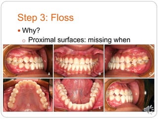 Step 3: Floss
 Why?
o Proximal surfaces: missing when
brushing
 
