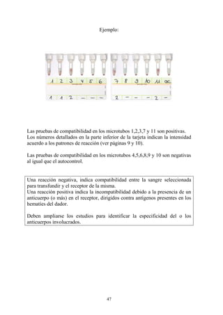 47
Ejemplo:
Las pruebas de compatibilidad en los microtubos 1,2,3,7 y 11 son positivas.
Los números detallados en la parte inferior de la tarjeta indican la intensidad
acuerdo a los patrones de reacción (ver páginas 9 y 10).
Las pruebas de compatibilidad en los microtubos 4,5,6,8,9 y 10 son negativas
al igual que el autocontrol.
Una reacción negativa, indica compatibilidad entre la sangre seleccionada
para transfundir y el receptor de la misma.
Una reacción positiva indica la incompatibilidad debido a la presencia de un
anticuerpo (o más) en el receptor, dirigidos contra antígenos presentes en los
hematíes del dador.
Deben ampliarse los estudios para identificar la especificidad del o los
anticuerpos involucrados.
 
