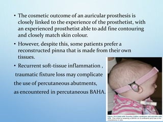 • The cosmetic outcome of an auricular prosthesis is
closely linked to the experience of the prosthetist, with
an experienced prosthetist able to add fine contouring
and closely match skin colour.
• However, despite this, some patients prefer a
reconstructed pinna that is made from their own
tissues.
• Recurrent soft-tissue inflammation ,
traumatic fixture loss may complicate
the use of percutaneous abutments,
as encountered in percutaneous BAHA.
 