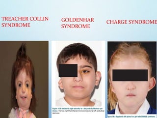 TREACHER COLLIN
SYNDROME
GOLDENHAR
SYNDROME
CHARGE SYNDROME
 