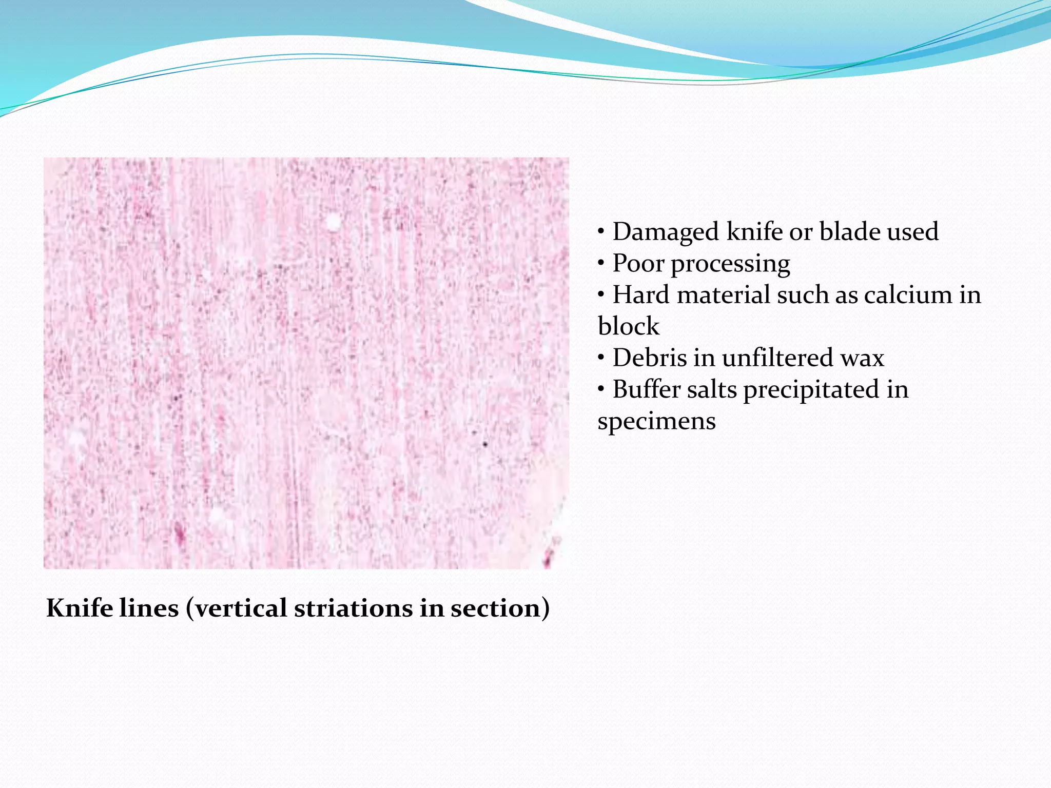Knife lines (vertical striations in section)
• Damaged knife or blade used
• Poor processing
• Hard material such as calcium in
block
• Debris in unfiltered wax
• Buffer salts precipitated in
specimens
 