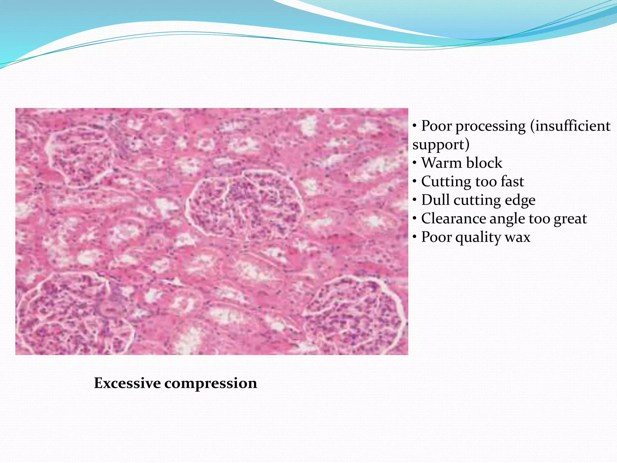 • Poor processing (insufficient
support)
• Warm block
• Cutting too fast
• Dull cutting edge
• Clearance angle too great
• Poor quality wax
Excessive compression
 