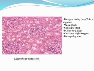 • Poor processing (insufficient
support)
• Warm block
• Cutting too fast
• Dull cutting edge
• Clearance angle too great
• Poor quality wax
Excessive compression
 