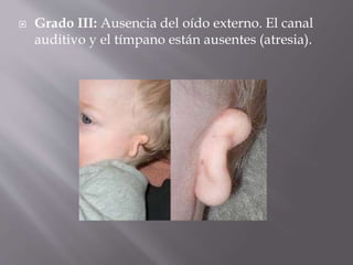  Grado III: Ausencia del oído externo. El canal
auditivo y el tímpano están ausentes (atresia).
 