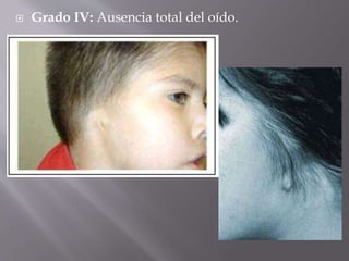  Grado IV: Ausencia total del oído.
 