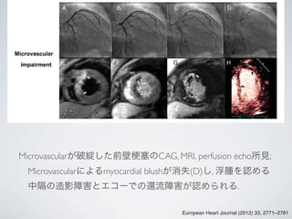 Microavulsion Microvascular angina | PDF