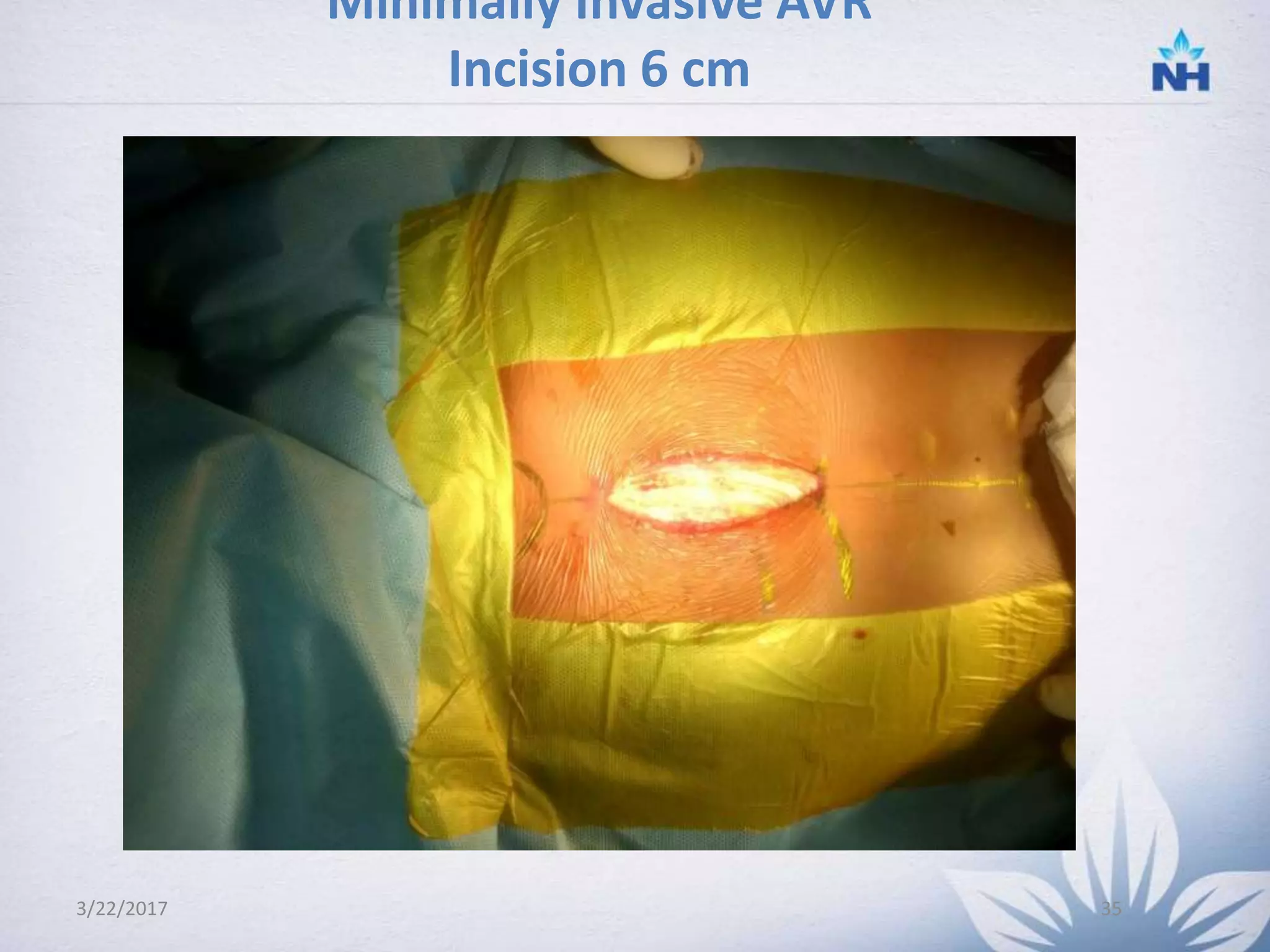 Minimally invasive cardiac surgery | PPTX