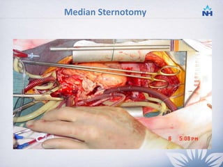 Minimally invasive cardiac surgery | PPTX